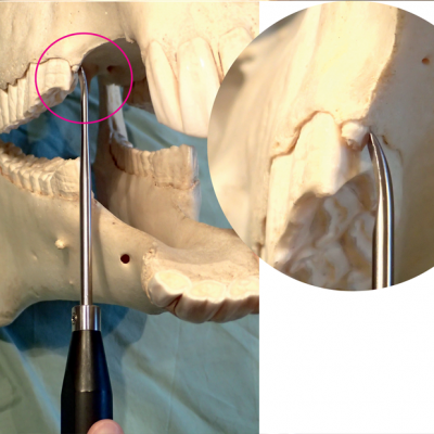 Wolf Tooth Extraction Set Handle, straight and concave curved inserts 4 and 5 mm